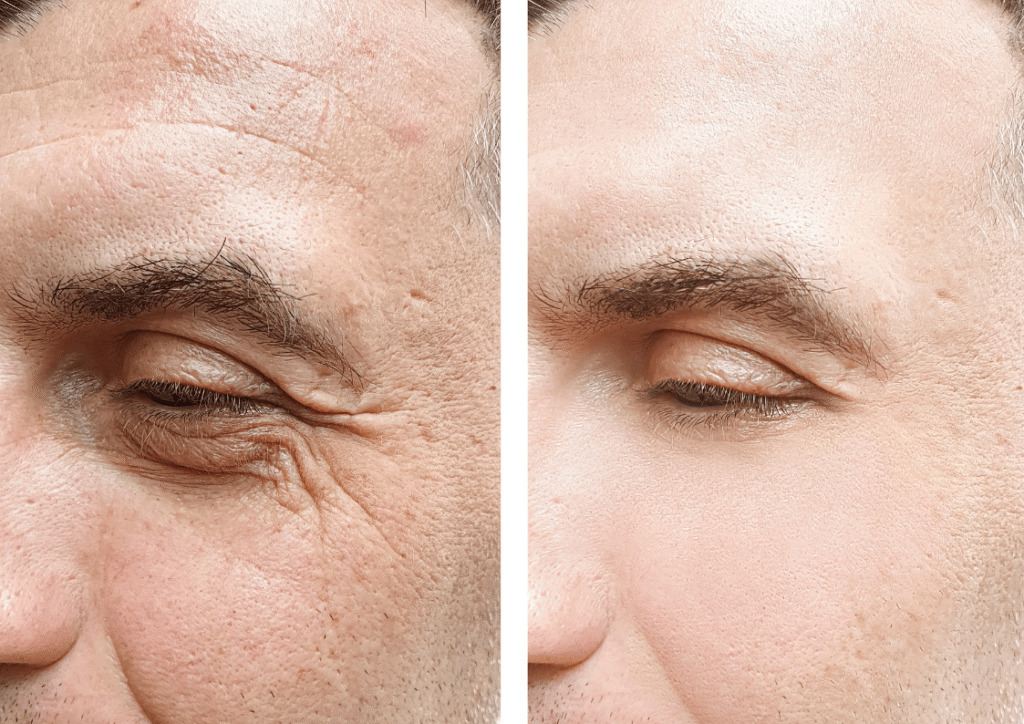 علاج التجاعيد