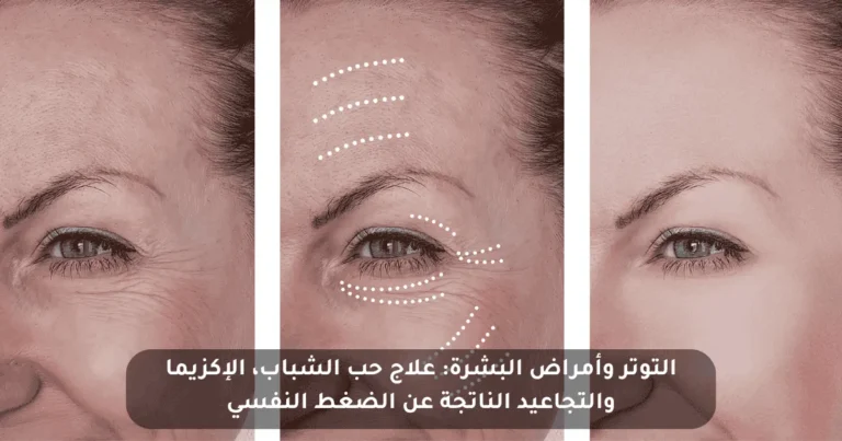 التوتر وأمراض البشرة: التجاعيد وحب الشباب والإكزيما