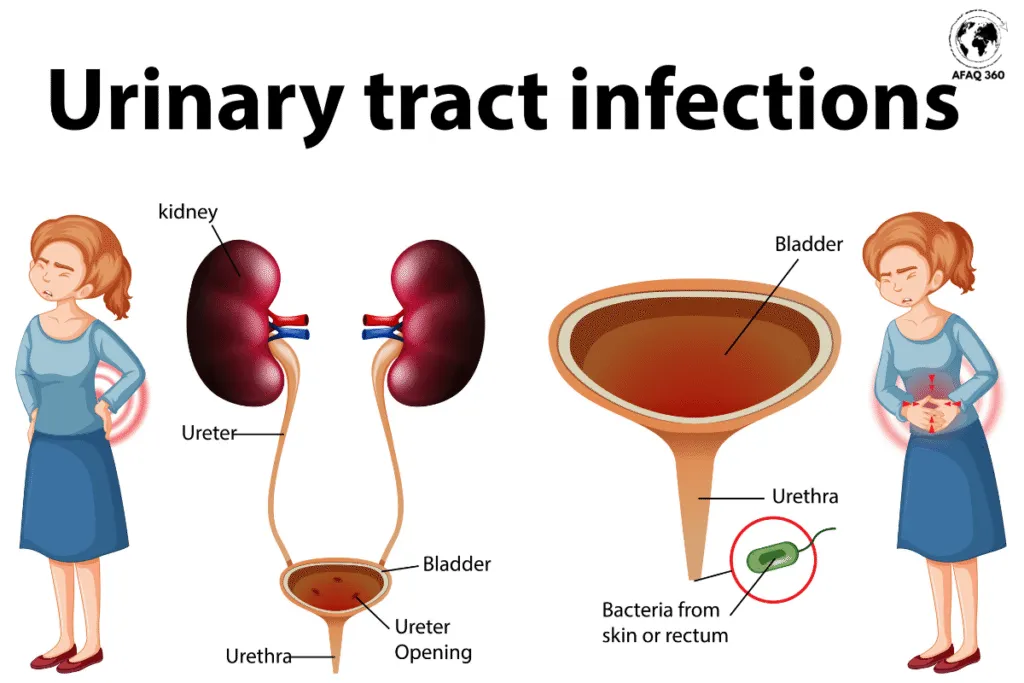التهاب الجهاز البولي (1) التهاب المسالك البولية عند المرأة