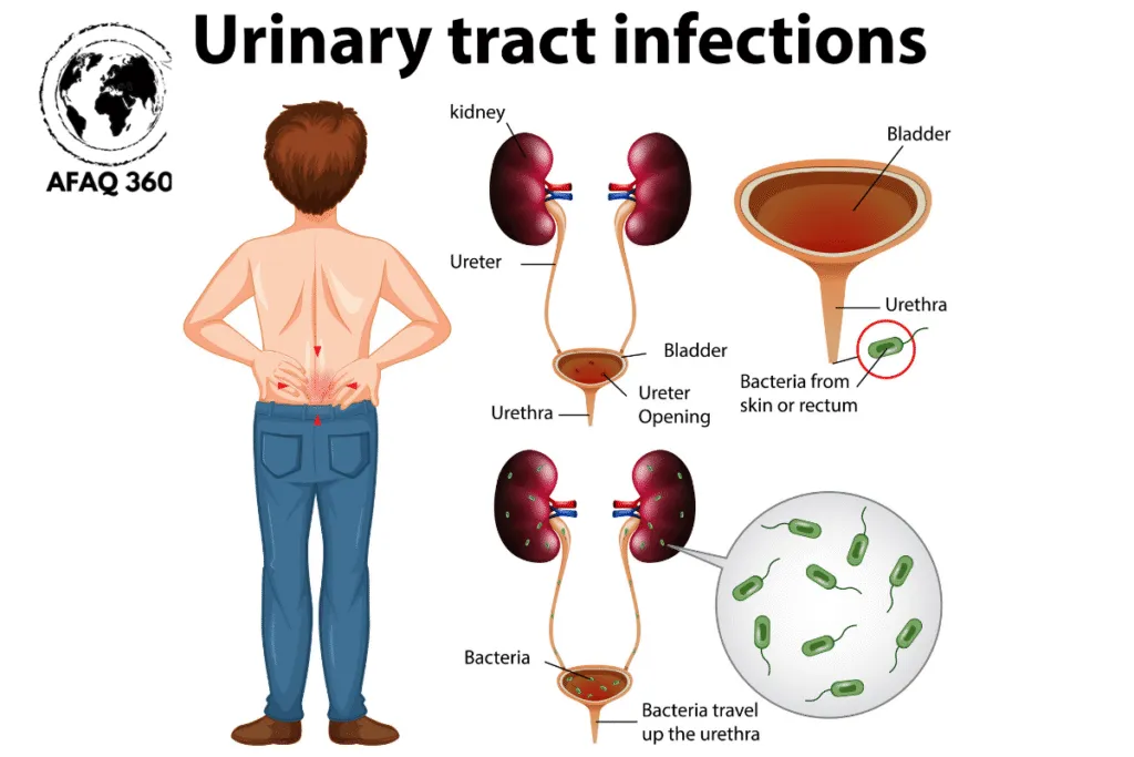 التهاب الجهاز البولي (2) التهابات الجهاز البولي
