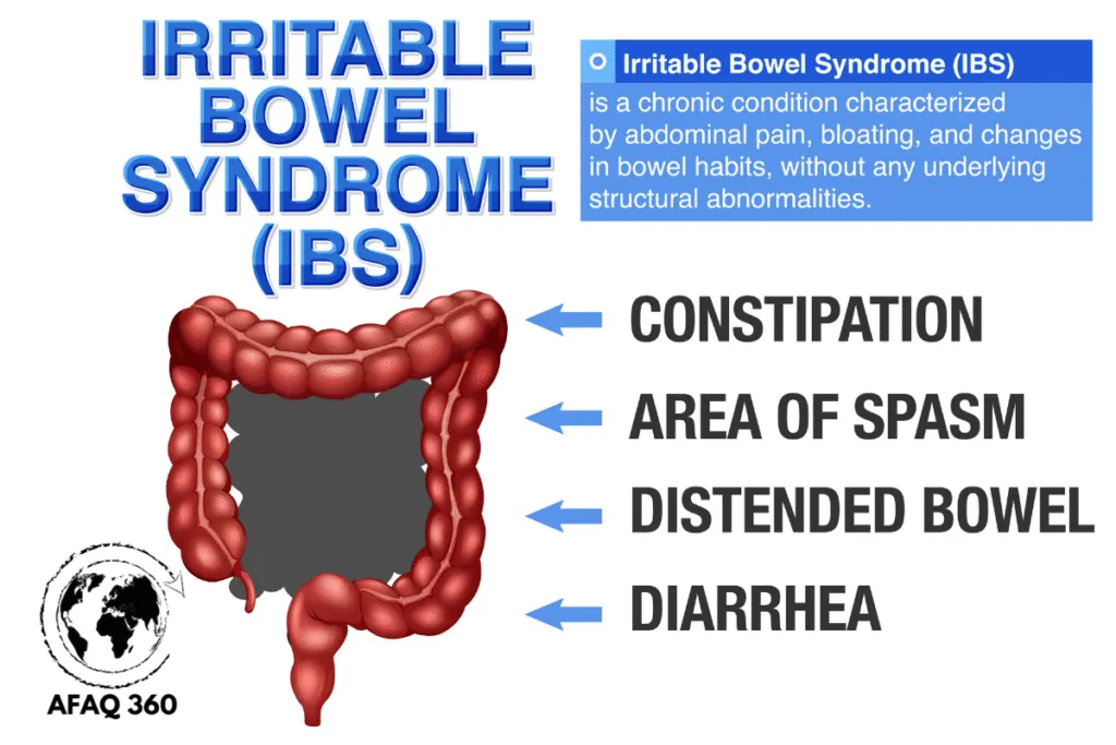 القولون العصبي: الدليل الشامل 